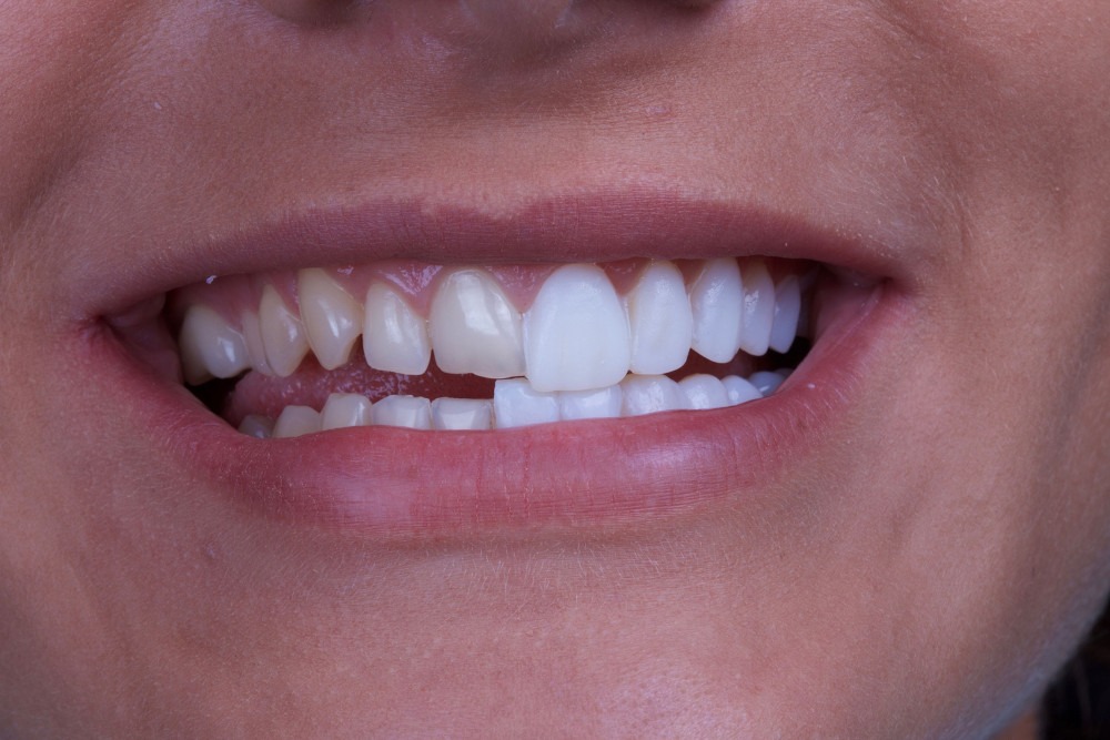veneers sutherland shire