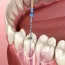 root canal treatment Guildford