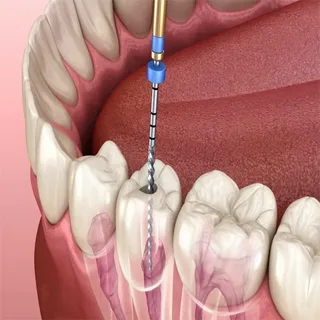 Why Is Root Canal Treatment In Guildford Important For Saving Natural Teeth?