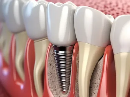 Making Tooth Replacement More Accessible with Affordable Dental Implants in Sydney